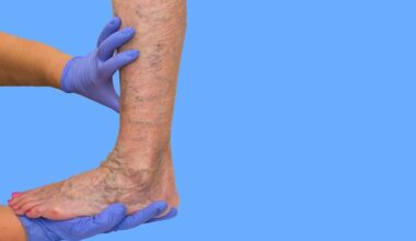 showing vascular blood clot and endothelial inflammation in venous thromboembolism in rheumatoid arthritis