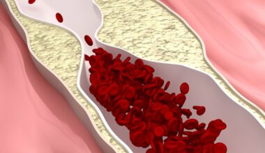 New study detects silent atherosclerosis in healthy young adults