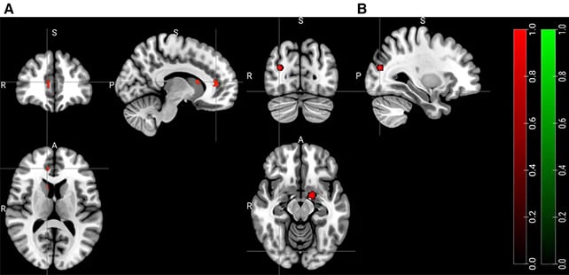 Brain scans