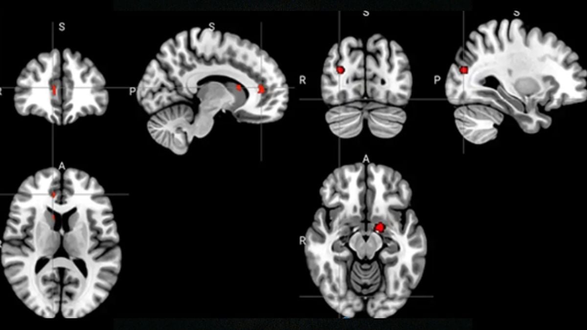 Acupuncture Seems to Rewire The Brain in Depression, Scans Reveal : ScienceAlert