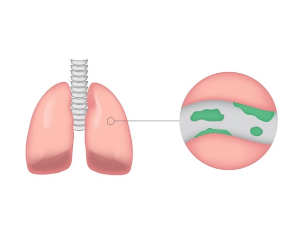 Women with shorter reproductive lifespan face higher risk of developing bronchiectasis