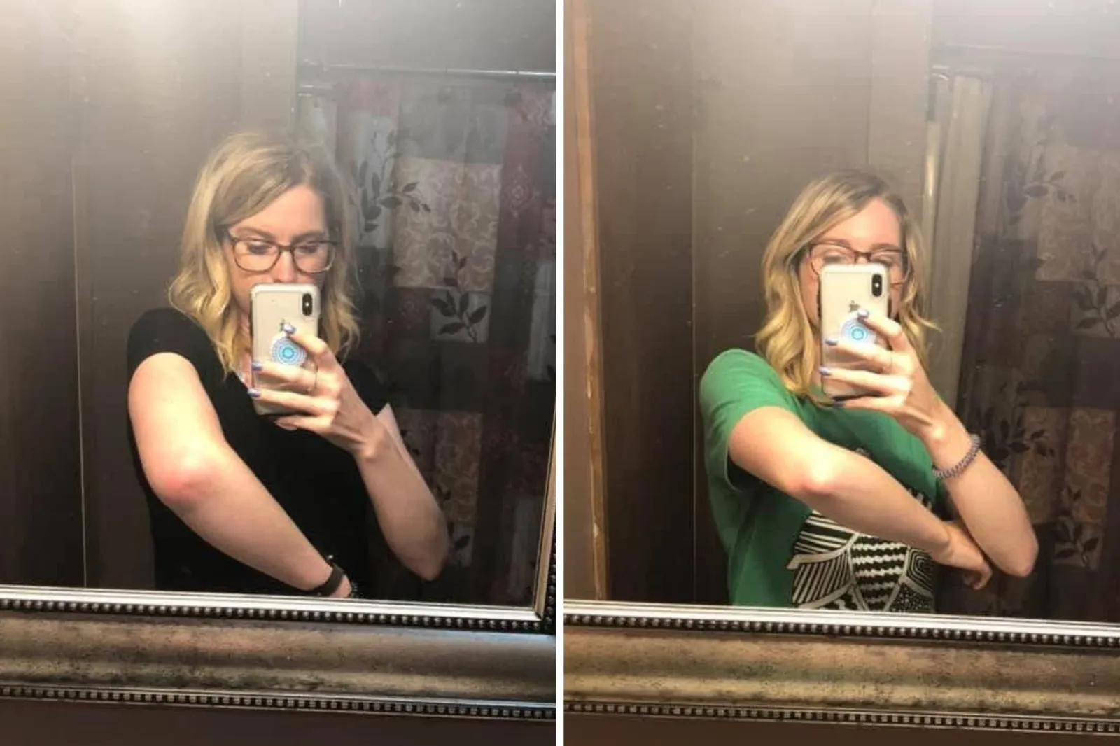 Devin Lark's swollen arm that prompted her to seek urgent care.