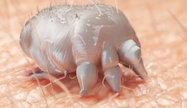 Scabies: Waikato University student says treatment barriers led to six infections