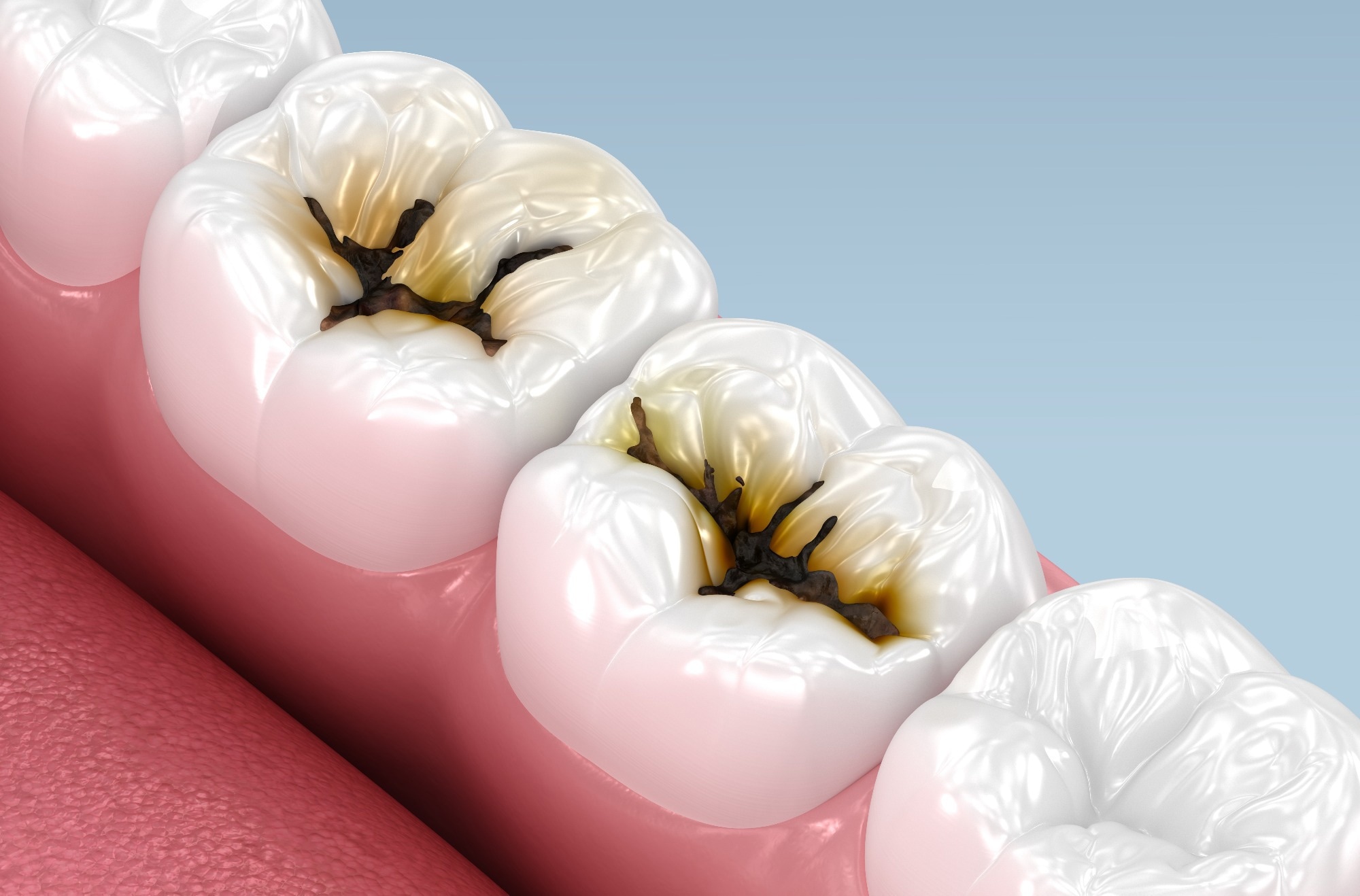 tudy: Efficacy of Silver Diamine Fluoride on Young Children With Severe Early Childhood Caries. Image Credit: Alex Mit / Shutterstock