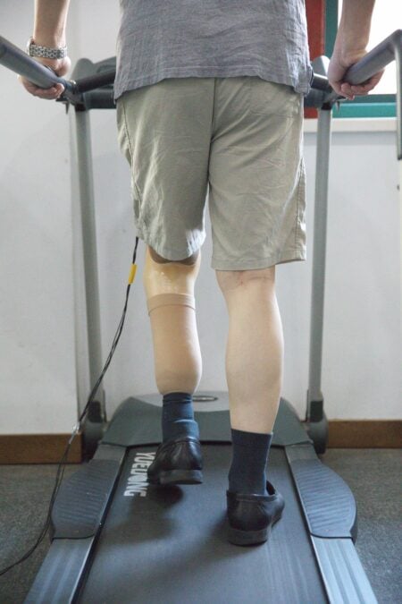 A lower-limb amputee running on a treadmill while wearing a sensor-integrated prosthesis.