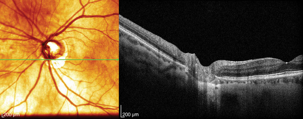 Enhanced depth imaging and swept-source OCT improve visualization of deeper structures, such as the choroid, to reveal thickness and vascular patterns.3
