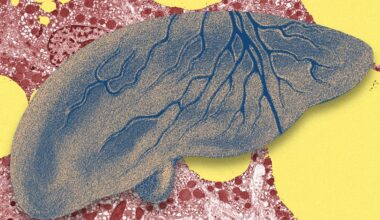 There’s a Fatty Liver Epidemic. AI Could Help Get Ahead of It