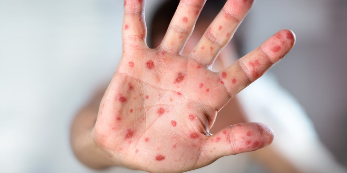 Connecticut confirms third measles case of 2026, highest since 2019