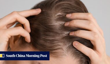 Arthritis drug restores 100% of hair on some patients with severe alopecia in global trial