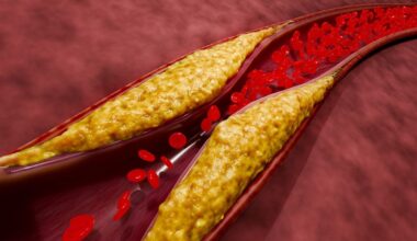 Atherosclerosis and plaque buildup in blood vessels due to high cholesterol