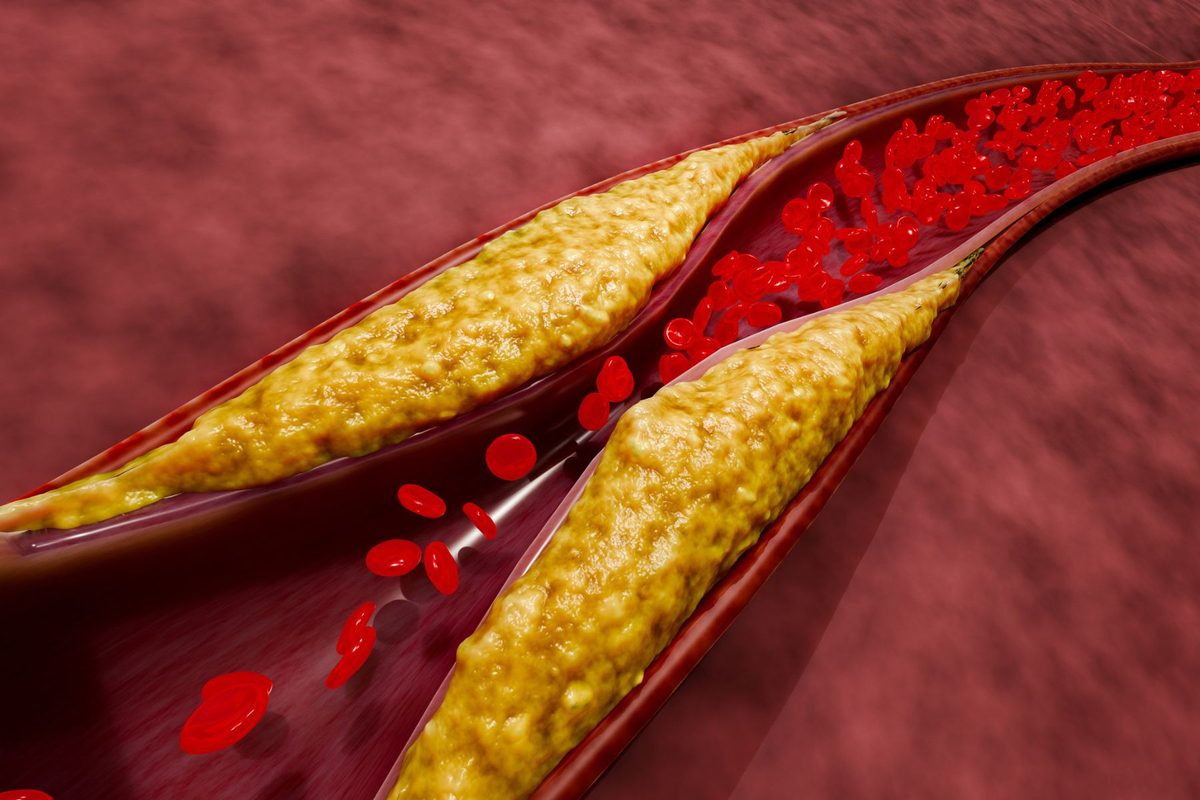 Atherosclerosis and plaque buildup in blood vessels due to high cholesterol