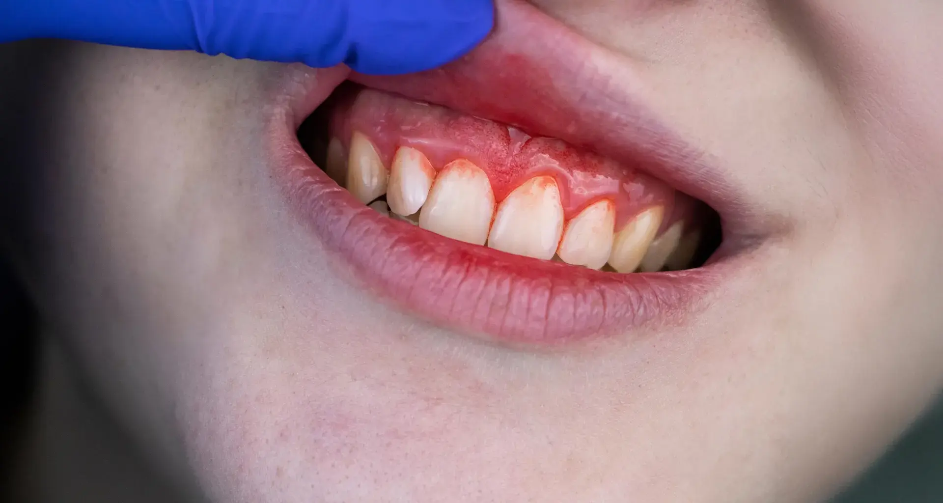 Common supplements rival antibiotics for severe gum disease