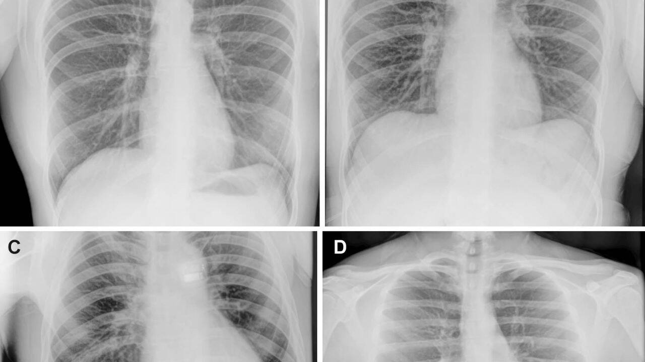 Representative preflight, in-flight, and post-flight chest radiographs. Radiographs of the chest were acquired (A) preflight by a crew member, (B, C) in-flight on day 3 after launch (L+3) by a crew member, and (D) post-flight by a non-crew operator using the same imaging protocol. Image Credit: Radiological Society of North America(RSNA) Quality of the space X-ray images