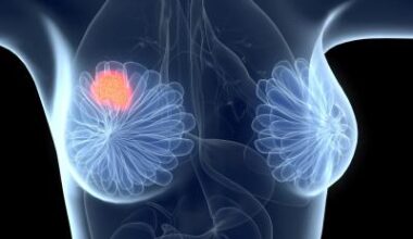 Breast cancer should be viewed as a spectrum, new study suggests • healthcare-in-europe.com