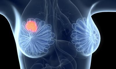 Breast cancer should be viewed as a spectrum, new study suggests • healthcare-in-europe.com