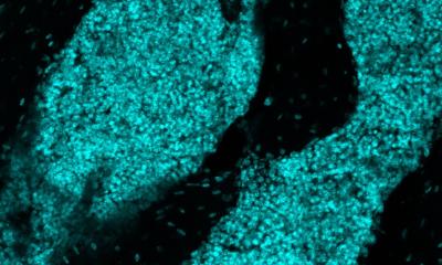 ‘Immune organ’ inside skull could help fight brain cancer • healthcare-in-europe.com