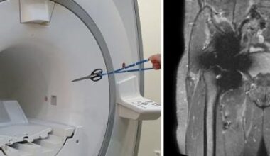 When metal meets magnet: Implant safety in MRI • healthcare-in-europe.com