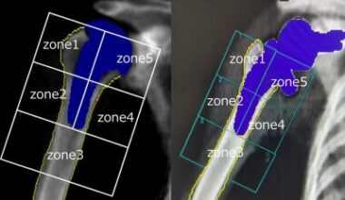 Research reveals bone loss after shoulder replacement surgery • healthcare-in-europe.com