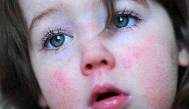 Scarlet fever case confirmed at Wellington school