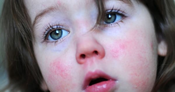 Scarlet fever case confirmed at Wellington school