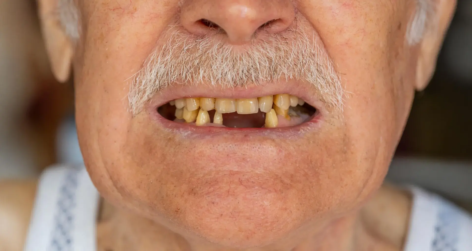 Tooth count may predict survival after pancreatic cancer surgery