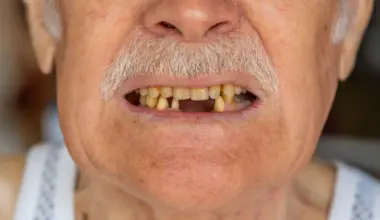 Tooth count may predict survival after pancreatic cancer surgery