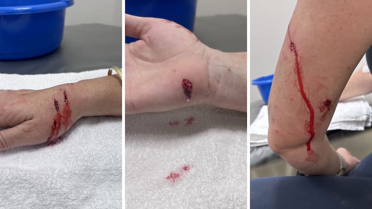 Sophie Greer was bitten on the hand and back of the arm by a Rottweiler while trying to protect her 10-month-old cavoodle Lottie.