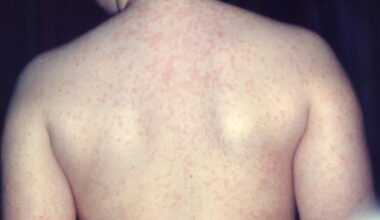 Chautauqua Co. reports first measles case in over 30 years