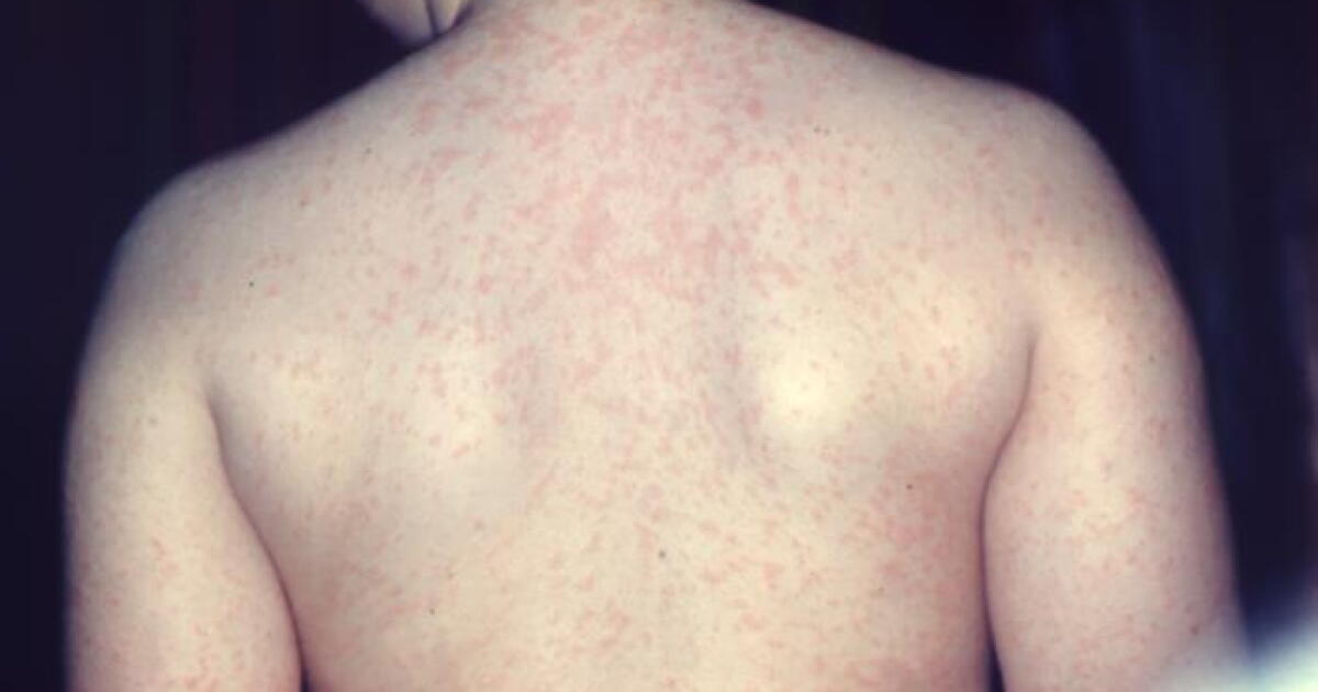 Chautauqua Co. reports first measles case in over 30 years