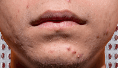 Where did all the acne go?