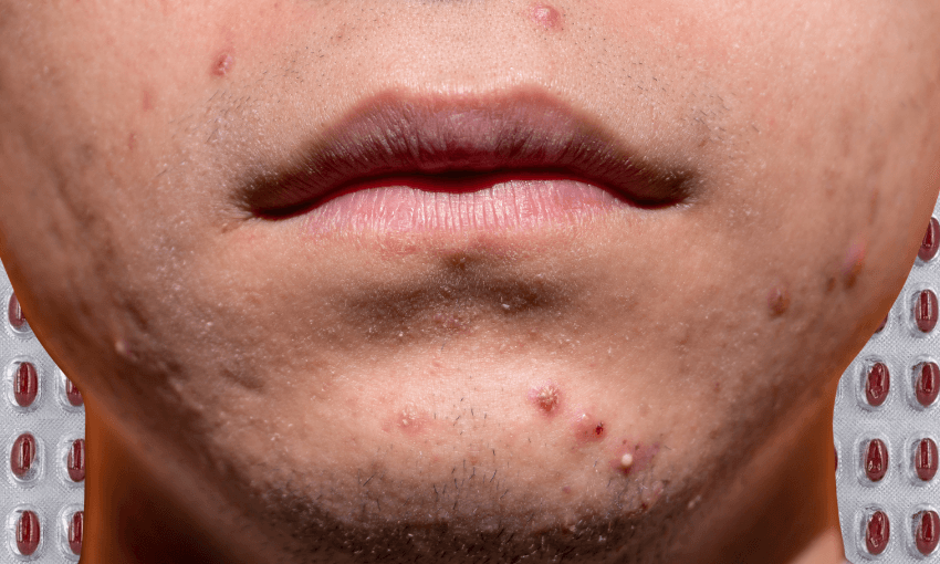 Where did all the acne go?