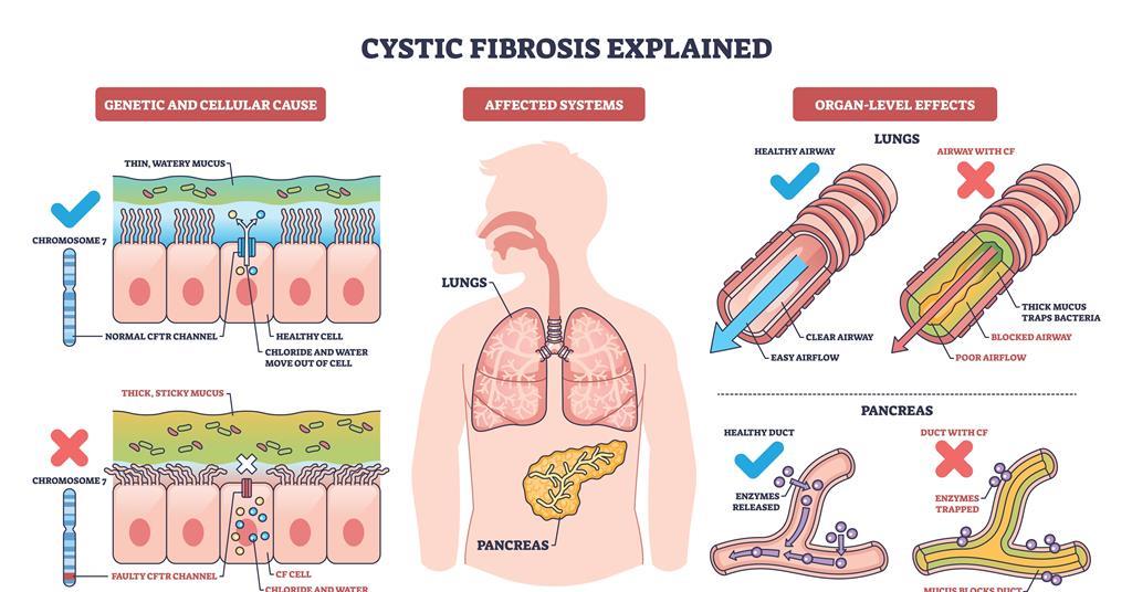 Suppressor tRNAs and lipid nanoparticles offer new approach to nonsense mutation cystic fibrosis
