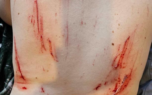 Some of the injuries on Kat Murray's back.