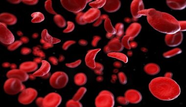 sickle cell