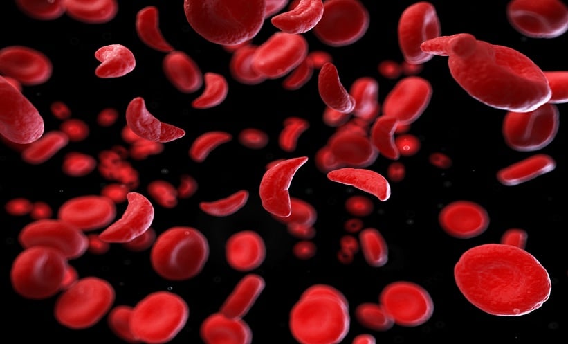 sickle cell