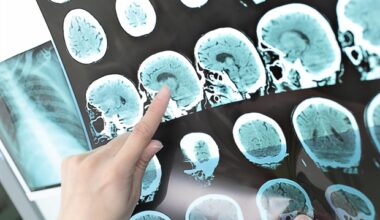 Immigrants face longer ICU stays after stroke in Canada