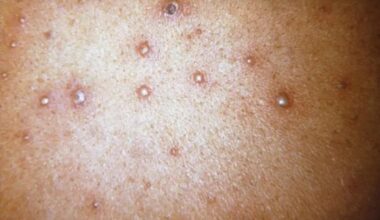 Ecuador records 4,891 chickenpox cases in 2026