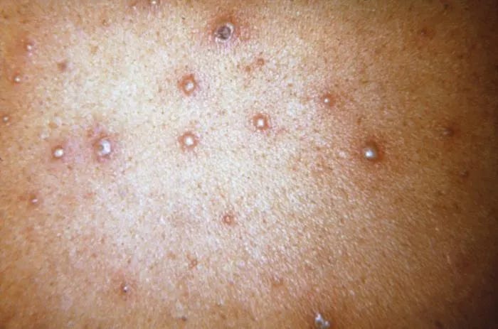 Ecuador records 4,891 chickenpox cases in 2026
