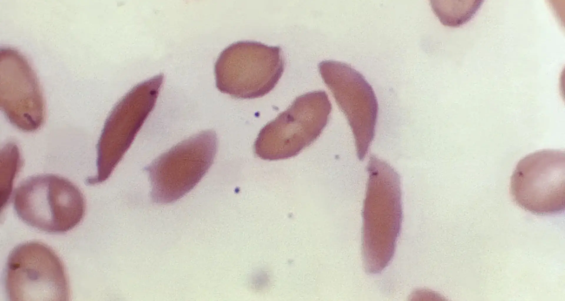 Sickle cell gene therapies offer new hope, accessing them is hard