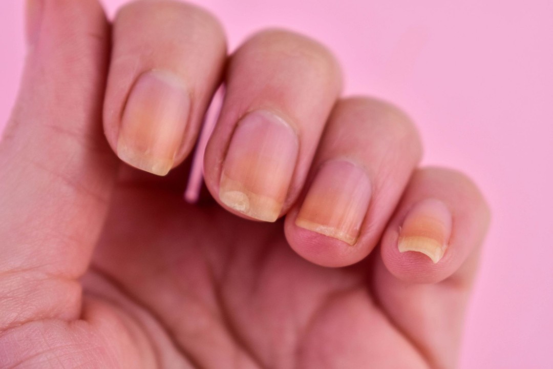 GLP-1 Users Report More Nail Detachments
