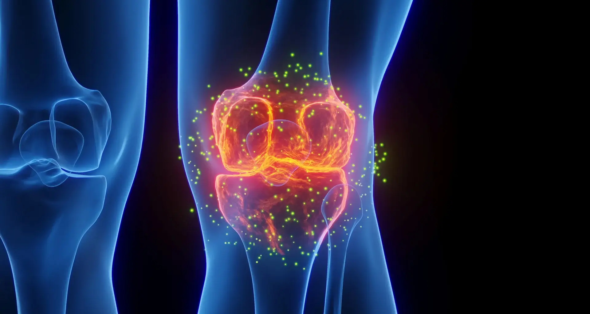 FDA-approved epilepsy drug may help reverse osteoarthritis damage