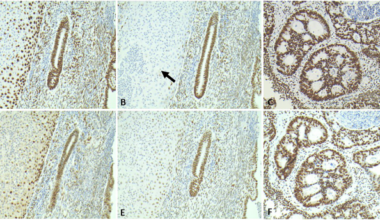 Characterisation of a Portuguese origin founder missense variant in MSH6