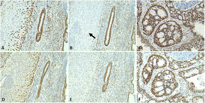 Characterisation of a Portuguese origin founder missense variant in MSH6