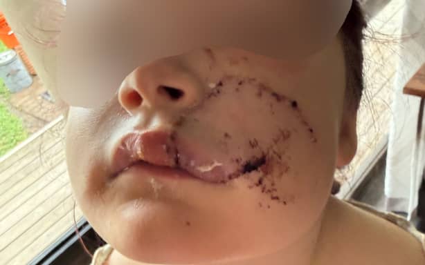 Dog attack - child victim blurred - 3 March 2026