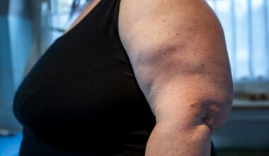 What it’s like to have lipoedema: Your weight is not your fault