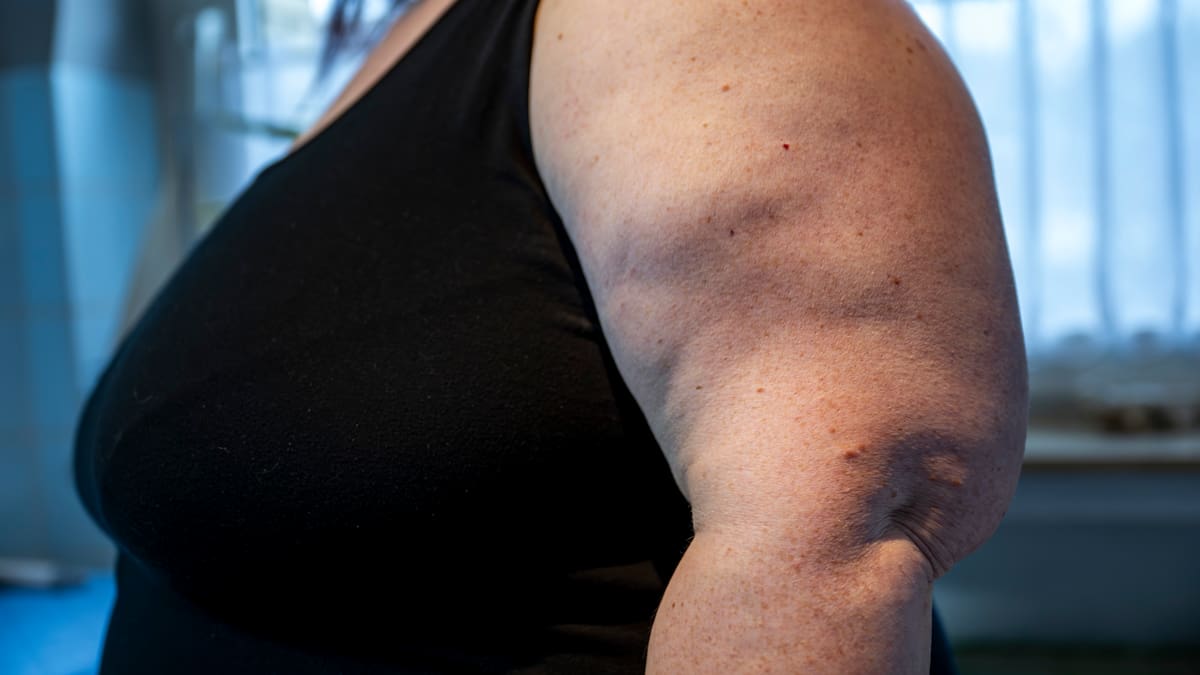 What it’s like to have lipoedema: Your weight is not your fault