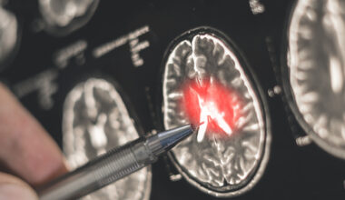 £80 million challenge launched to speed up dementia diagnosis