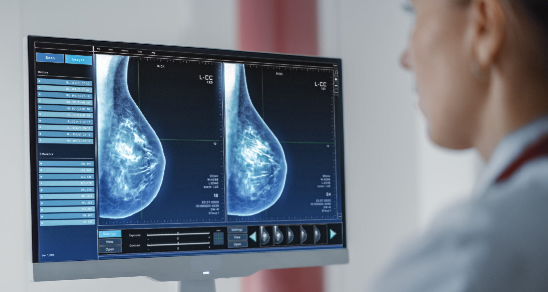 AI Helps Close Breast Cancer’s Deadliest Gaps
