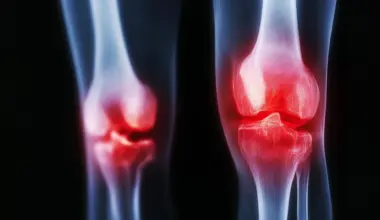 Why painful arthritis can return stronger after cancer treatment