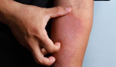 Desperate dad pleads for help with son's extreme eczema